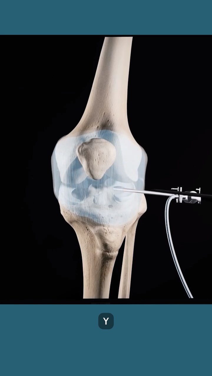 Cirugía de reconstrucción del Ligamento Cruzado Anterior (LCA)