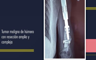 Tumor maligno de húmerop con resección amplia y compleja
