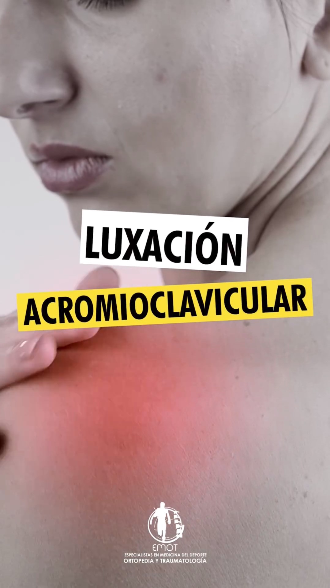 Luxación Acromioclavicular