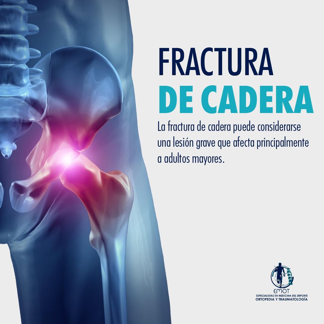 Fractura de cadera