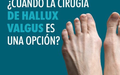 ¿Cuándo la cirugía de Hallux Valgus es una opción?