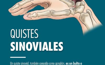 Quistes Sinoviales