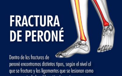 Fractura de Peroné