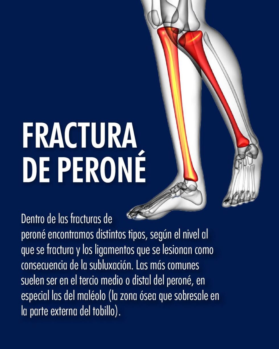 Fractura de Peroné | Dr. Jose Mario Dorantes Rodríguez, Ortopedista y ...