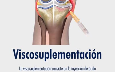 Viscosuplementación
