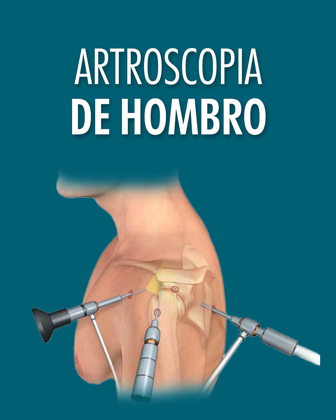 Artroscopia de Hombro