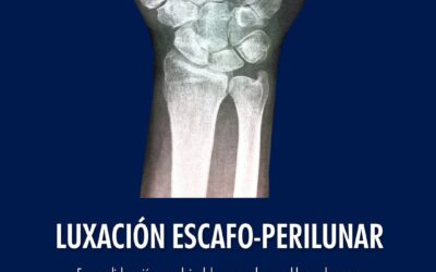 Luxación Escafo-Perilunar