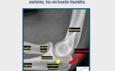 Luxación de codo, ya reducida