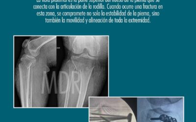 Fracturas Proximales de Tibia