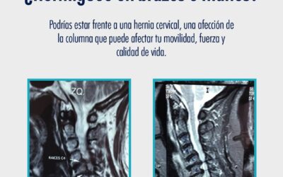 ¿Dolor constante en el cuello? ¿Hormigueo en brazos y manos?
