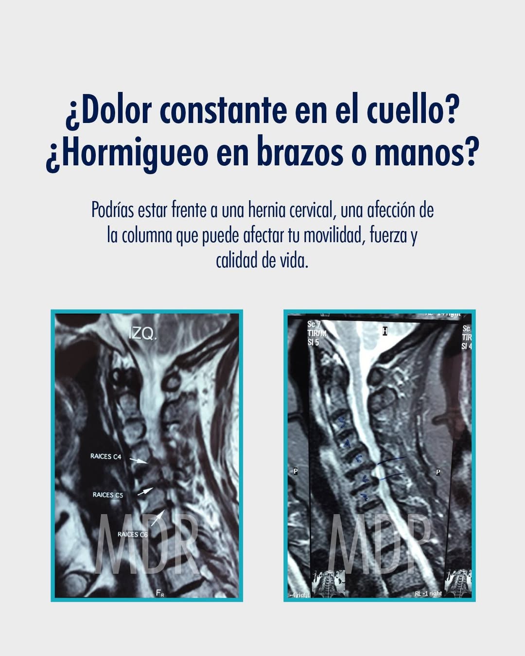 ¿Dolor constante en el cuello? ¿Hormigueo en brazos y manos?
