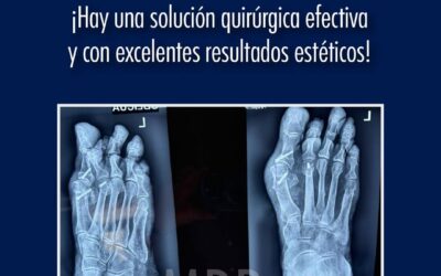 ¿Tienes juanetes?