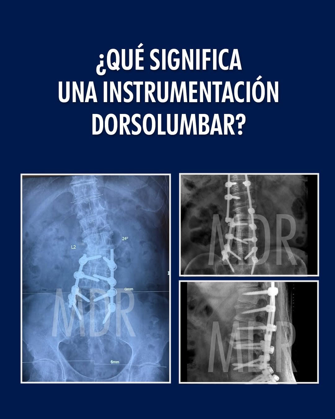 ¿Qué significa una instrumentación Dorsolumbar?