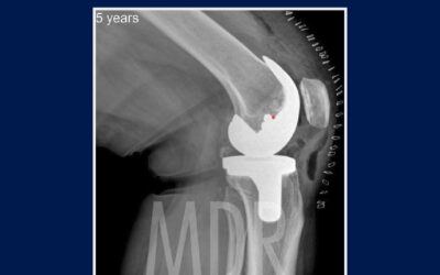 Tipos de Prótesis de Rodilla