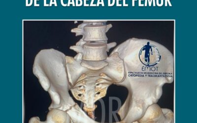 Caso de éxito en paciente con Epifisiolistesis de la Cabeza del Fémur