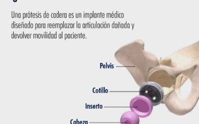 Prótesis de Cadera ¿Cómo se arma y cuándo se recomienda?