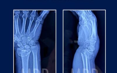Fractura de Muñeca: Más común de lo que imaginas