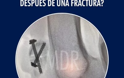 ¿Cómo se reestablece la superficie articular después de una fractura?