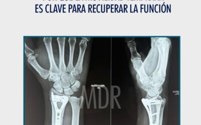 Fractura de Muñeca: Por qué la Movilidad Temprana es Clave para Recuperar la Función