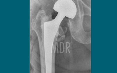 Prótesis Bipolar en Factura de Cadera