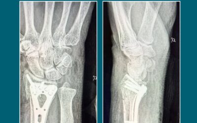 Fractura de Radio Distal: Cuando la Muñeca Pierde la Alineación