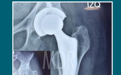 Caso de Éxito: Paciente con Prótesis de Cadera