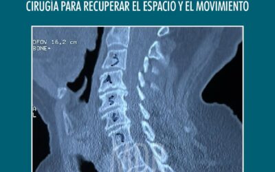 Cuando el desgaste cervical comprime los nervios