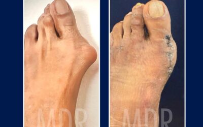 Caso de Hallux Valgus Severo