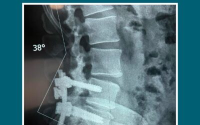 Inestabilidad Degenerativa de Columna