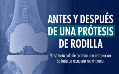 Antes y Después de una Prótesis de Rodilla