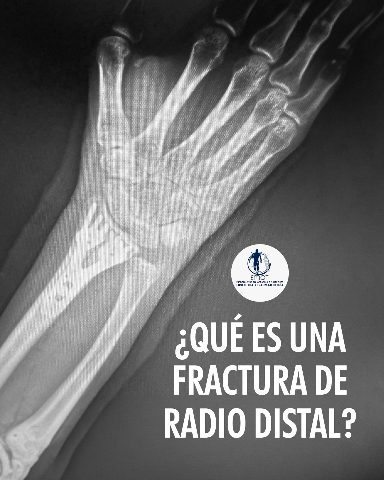 ¿Qué es una fractura de Radio Distal?